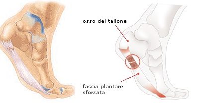 Fascite plantare: il consiglio del fisioterapista