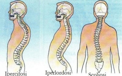 Ipercifosi (dorso Curvo)