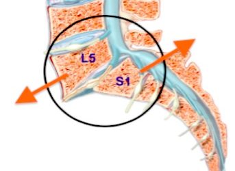 Sai distinguere spondilo lisi e spondilo listesi?