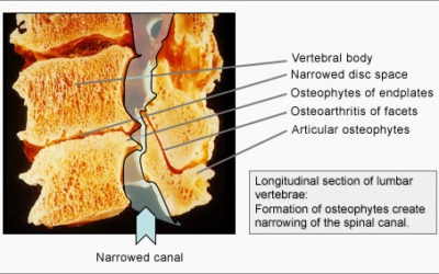 Stenosi vertebrale: meglio la riabilitazione del bisturi