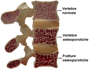 crollo vertebrale osteoporosi
