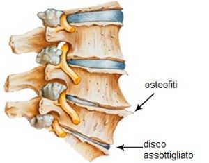 esempio di degenerazione discale ed osteofita