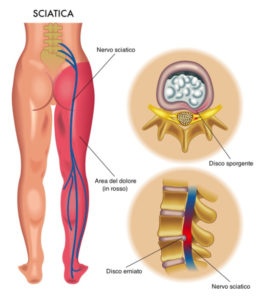 sciatalgia