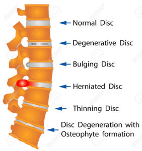 vari tipi di patologie del disco intervertebrale