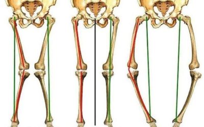 Ginocchio valgo e artrosi: genesi e cura