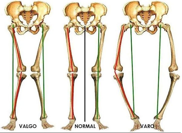 piedi gambe valgo fisiosan