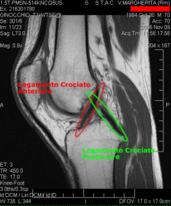 un immagine di risonanza che permette di visionare lo stato di salute dei due legamenti crociati