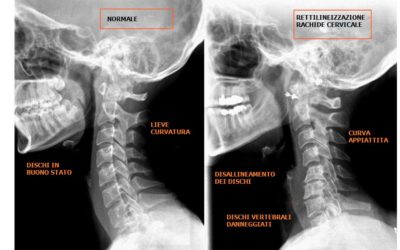 Come ripristinare la lordosi cervicale in caso di sua “rettificazione”