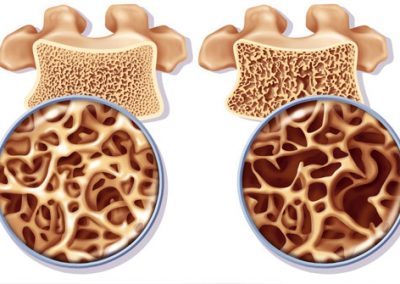 Cura Osteoporosi Trieste