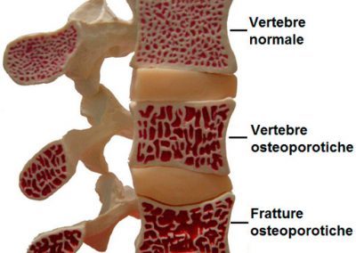osteoporosi-vertebrale
