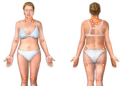 sintomi-della-fibromialgia