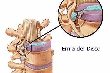 Ernia del disco, linee guida su come intervenire