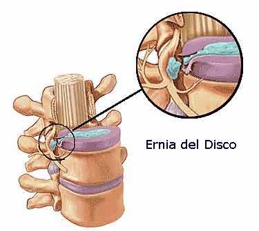 Cura Ernia Discale