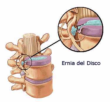 Cura Ernia Discale