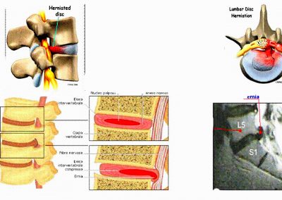 ernia al disco