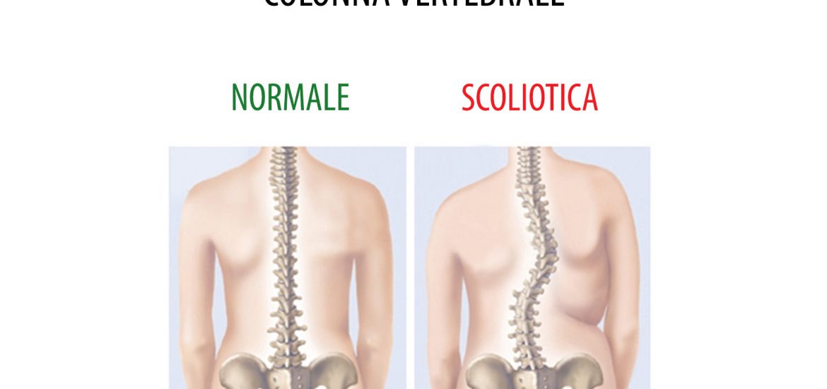 Cura Scoliosi Gravi : Trattamenti per Scoliosi a Trieste