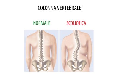 Rottura del legamento crociato anteriore nelle donne