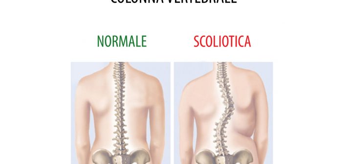 Cura Scoliosi Gravi : Trattamenti per Scoliosi a Trieste