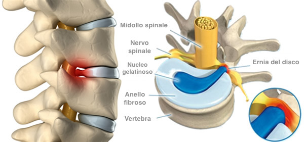 panca inversione fisiosan fisioterapia