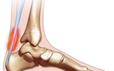 La tendinopatia Achillea nei runner: dalla diagnosi alla guarigione
