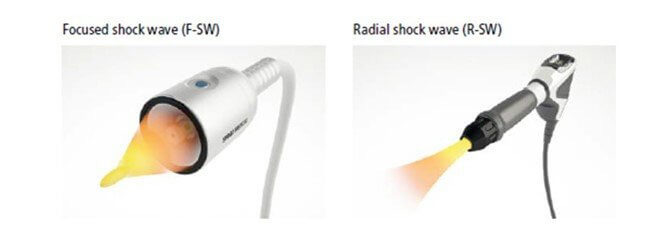 Differenza tra onde d'urto focali e onde d'urto radiali