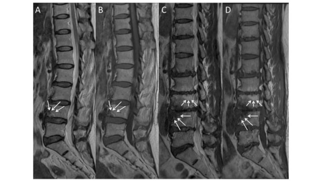 Degenerazione del disco intervertebrale infezioni e asse intestino-disco_cambiamenti modic