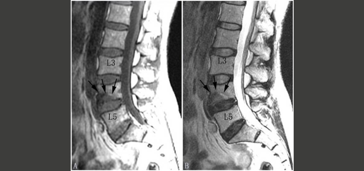 Degenerazione del disco intervertebrale infezioni e asse intestino-disco_diagnosi e trattamento