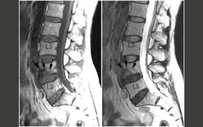 Degenerazione del disco intervertebrale, infezioni e asse intestino-disco: nuove frontiere nella diagnosi e nel trattamento