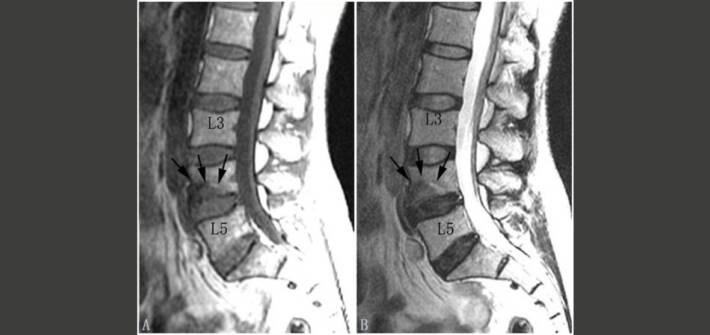 Degenerazione del disco intervertebrale infezioni e asse intestino-disco_diagnosi e trattamento