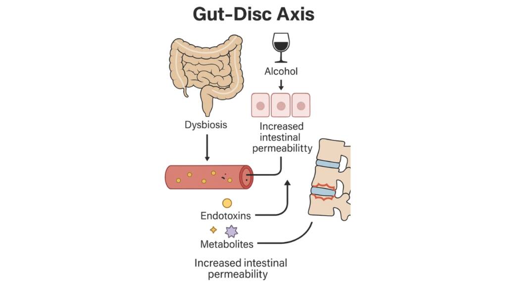 Degenerazione del disco intervertebrale infezioni e asse intestino-disco_gut disc axis