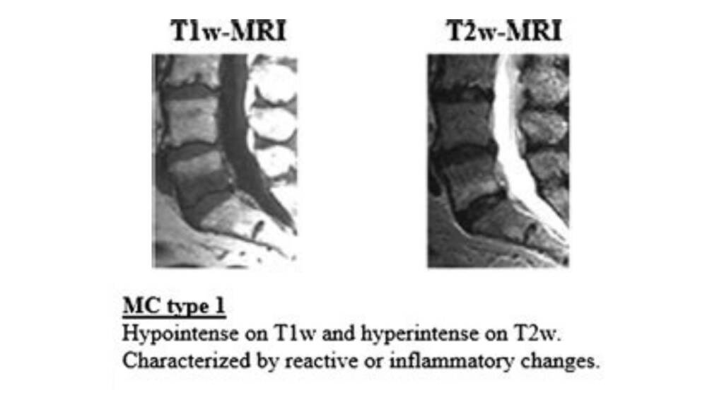 Degenerazione del disco intervertebrale infezioni e asse intestino-disco_modic tipo 1