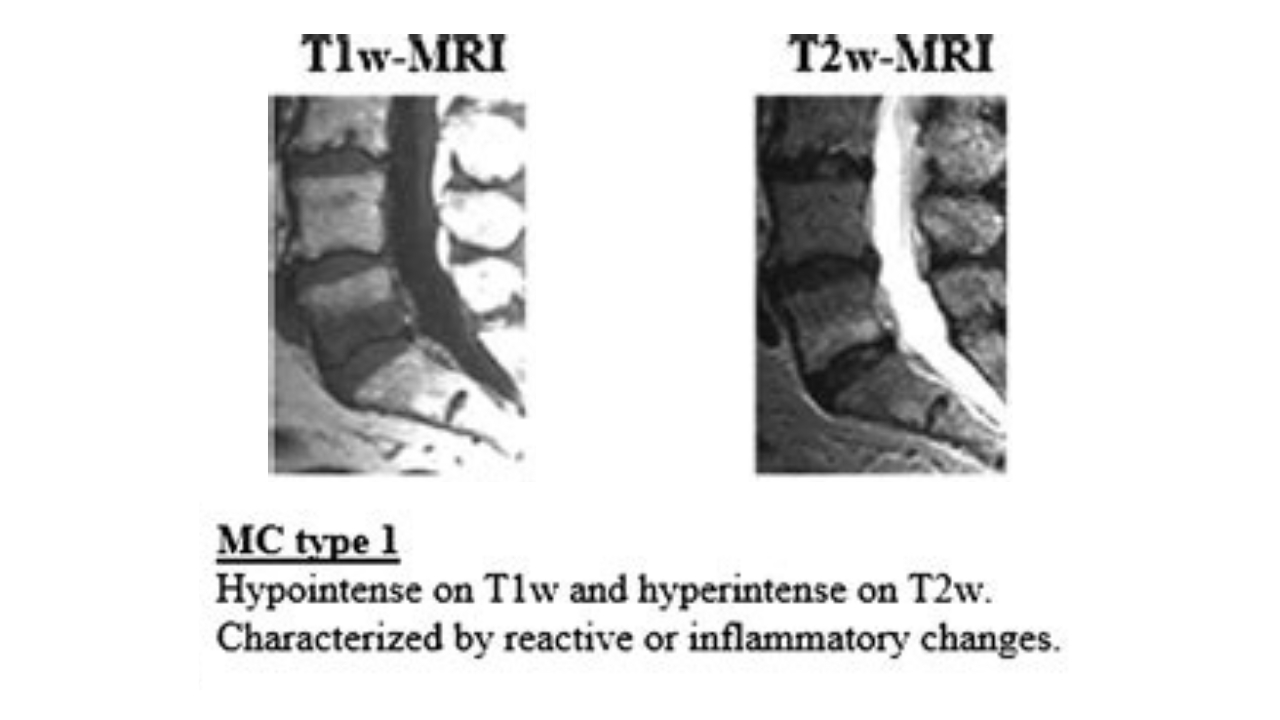 Degenerazione del disco intervertebrale, infezioni e asse intestino ...