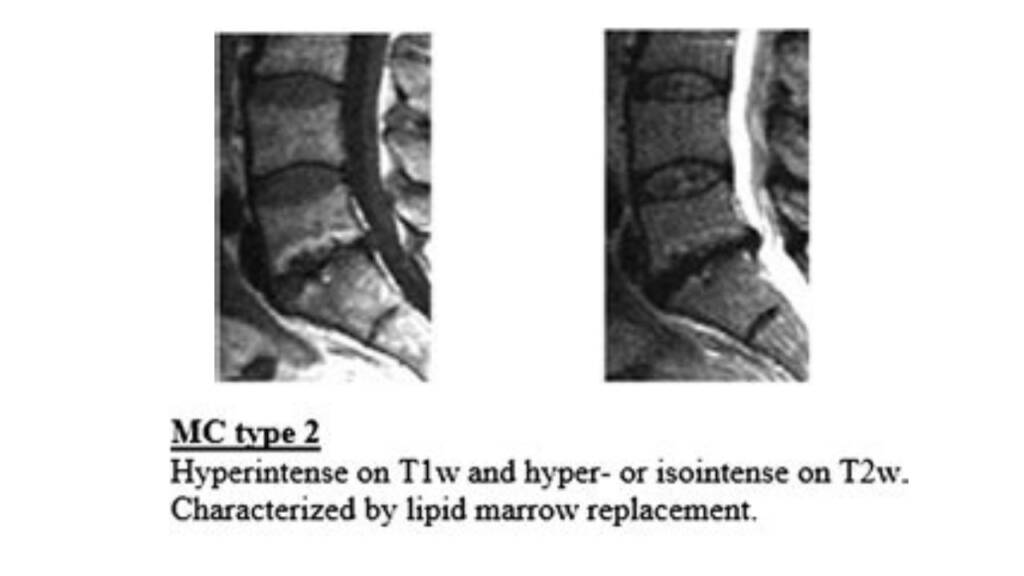 Degenerazione del disco intervertebrale infezioni e asse intestino-disco_modic tipo 2