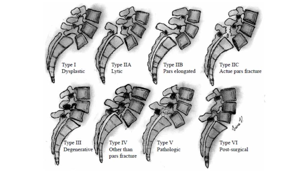 Spondilolistesi degenerativa_colonna vertebrale (1)