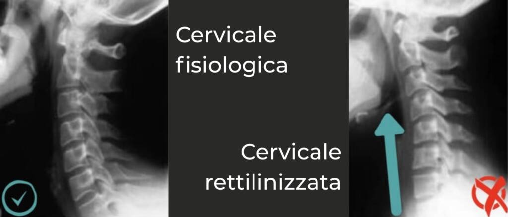 Lordosi cervicale rettilineizzazione verso cervicale fisiologica Lordosi cervicale rettilineizzazione e dolore cervicale