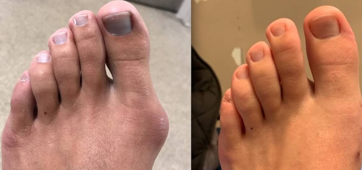 Alluce valgo cause, sintomi e rimedi efficaci (quando serve davvero l’intervento)