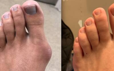 Alluce valgo: cause, sintomi e rimedi efficaci (quando serve davvero l’intervento?)