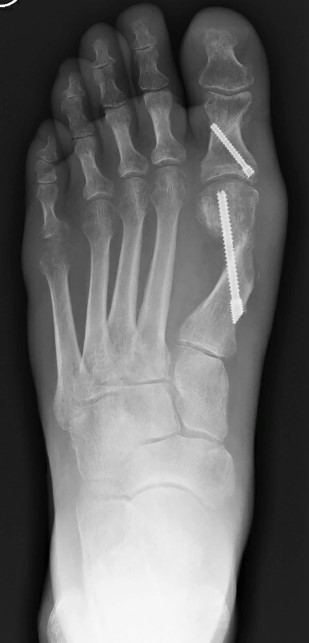 alluce_valgo_risonanza