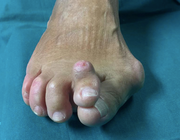 alluce_valgo_sintomi